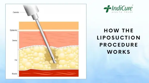 How the liposuction procedure works How the liposuction procedure works